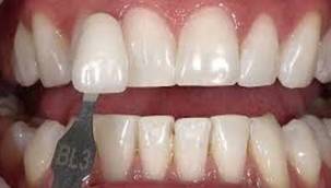 Diş Beyazlatma Tedavisi Nedir ?