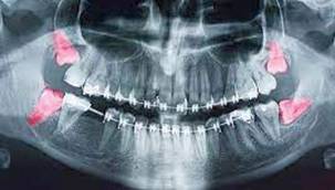 Yirmi Yaş Dişleri Nedir?